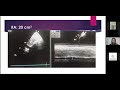 Webinar 1 Pulmonary Hypertension