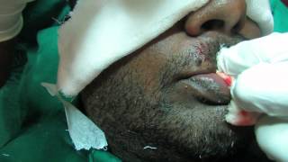 preview picture of video 'Mustache Hair Transplantation in Bangalore'