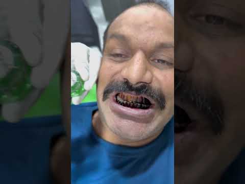 Teeth whitening powder #dentist  #dentalprosthesis  #smiledesigndental  #duet  #dentalcare