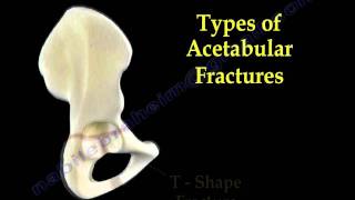Acetabular Fractures - Everything You Need To Know - Dr. Nabil Ebraheim
