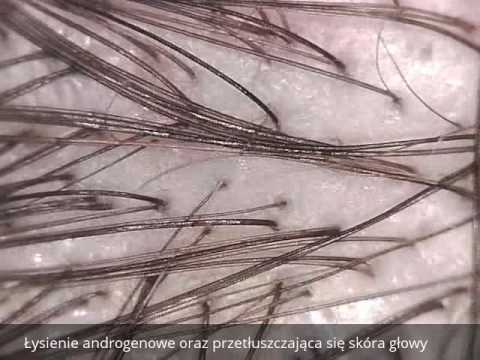 Przeszczep włosów w Turcji Wypadanie włosów po chemioterapii, jak odzyskać