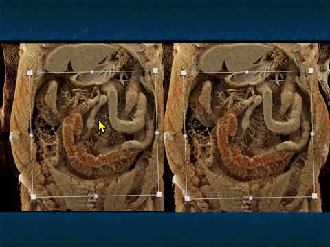 CT Evaluation of Small Bowel Obstruction - Part 1