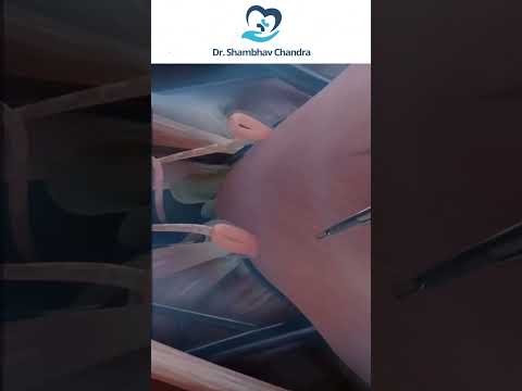Laparoscopic Total Extraperitoneal (TEP) Inguinal Hernia Repair #shorts #shortvideo