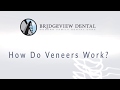 Bridgeview Dental in west Austin offers porcelain veneers. Call to book a consultation with top rated dentist Dr. Lance Loveless