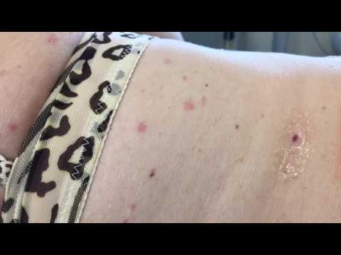 Che possono ferire vicino alla parte posteriore Cataplasma per dolori articolari con Dimexidum e novocaine