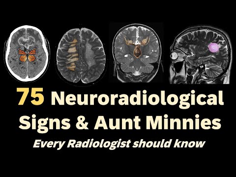 75 Neuroradiological Signs every Radiologist should know!