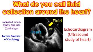 What do you call fluid collection around the heart?
