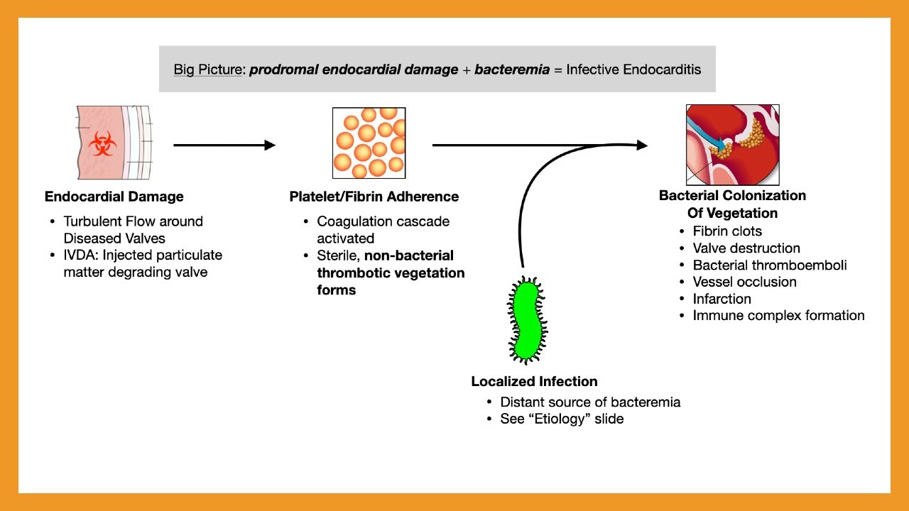 Infective Endocarditis