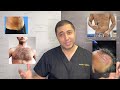 Can Pubic Hair Be Transplanted To The Scalp? | Juvida Clinics