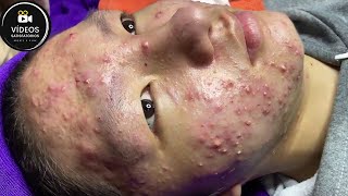 Extração Profunda de Cravos e Espinhas | Acne, Pústulas, Pontos Negros – Limpeza Relaxante🤩