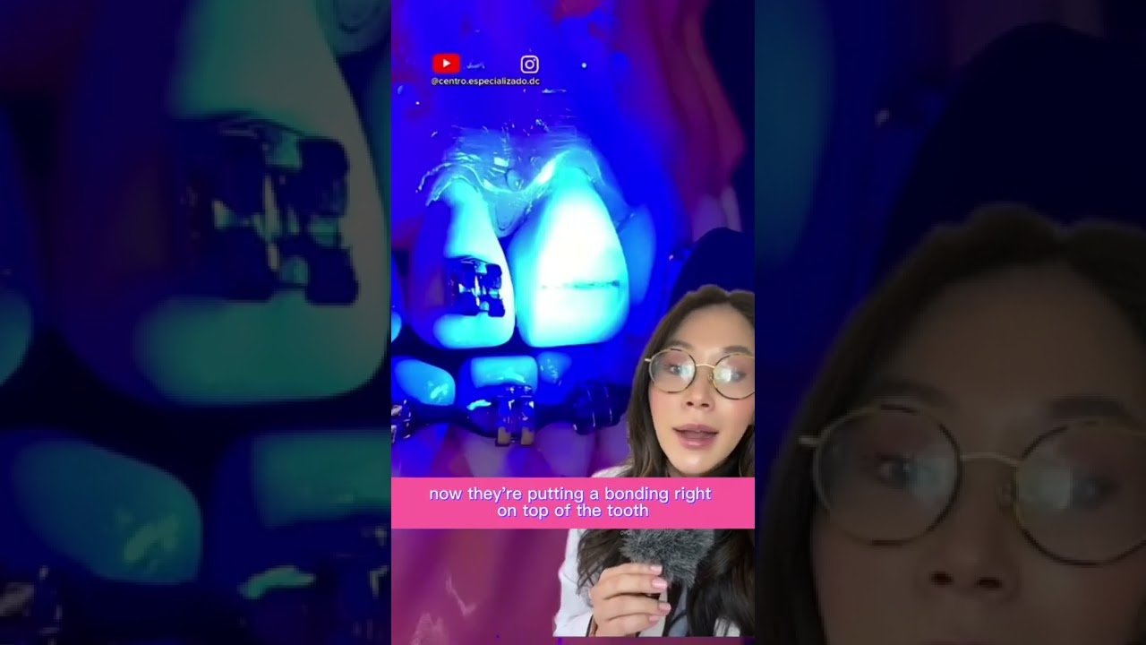 Attaching braces bracket. #braces #brackets #orthodontics #dentist