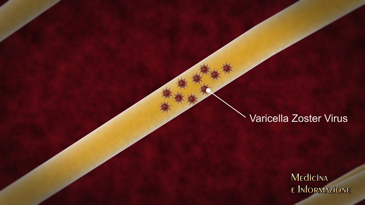 Herpes Zoster (Fuoco di Sant'Antonio) nuovo vaccino efficace e duraturo anche negli anziani