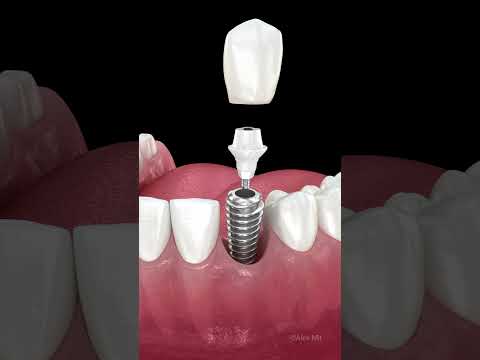 Dental implant installation and crown placement #dentalimplants #implants #teeth