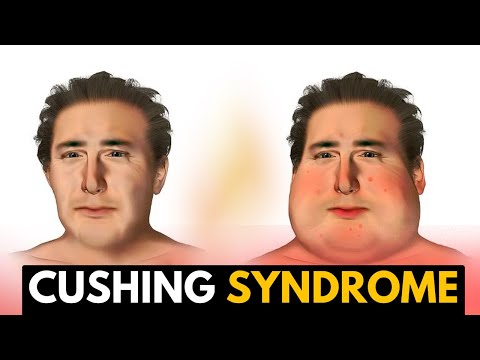 Cushing Syndrome, Causes, Signs and Symptoms, Diagnosis and Treatment.
