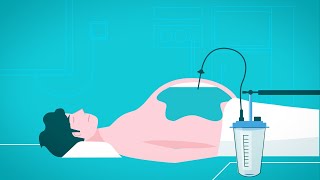 Alfapump: un nouveau traitement de l’ascite pour une meilleure qualité de vie