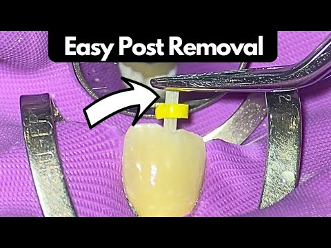 Efficient Fibre Post Removal Technique: A Step-by-Step Guide