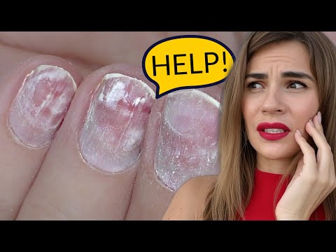 Can You Do Extensions on DAMAGED Nails!? It Depends…