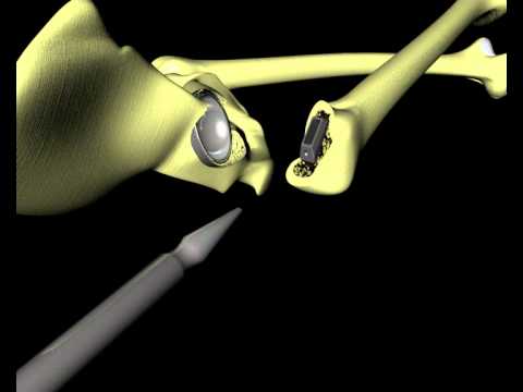 Differisce da CT risonanza magnetica della caviglia Piaghe sulle articolazioni delle dita