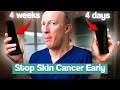 Prevent Squamous Cell Carcinoma SCC New 4 Day Treatment EFUDIX ALTERNATIVE