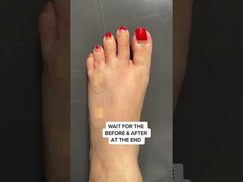 Lengthening Short Toes
