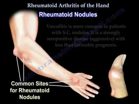 Merev ízületek rheumatoid arthritisben