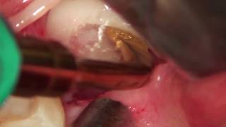 preview picture of video 'extraction of lower wisdom tooth'