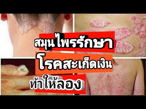 โรคสะเก็ดเงินในคนหนุ่มสาว ครีมทำให้ผิวนวลกลาก