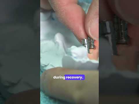 Curious about Dental Implant Surgery?