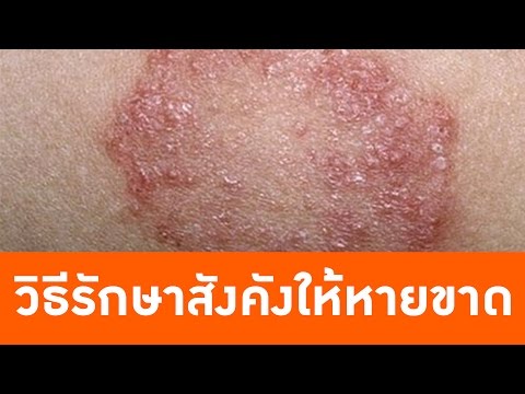 น้ำผึ้งโรคสะเก็ดเงินกระเทียม ครีมโรคสะเก็ดเงินจีนหลอดสีเขียว