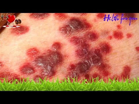 Saúde -  Saiba quais são os principais sintomas da AIDS