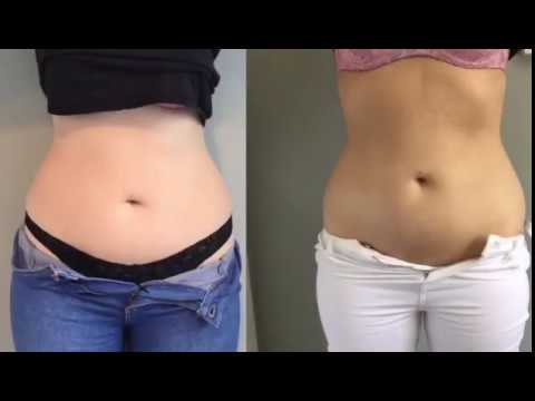 Fat Freezing Video with results