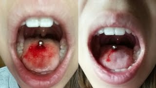 Piercing de la lengua infectado, que hacer