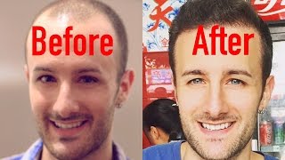 ENTIRE Hair Transplant Surgery Video - Beginning to End