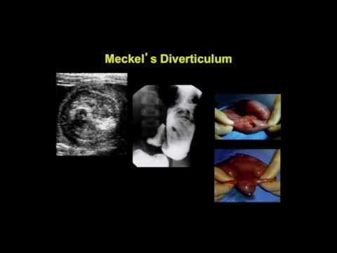 Sonographic Imaging of the Acute Pediatric Abdomen