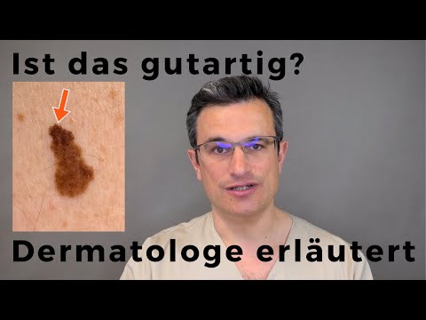 Gefährliche Muttermale erkennen