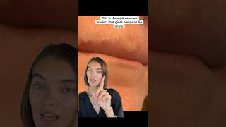 Have bumps on lip line This is probably why🥹😳#skincare #acne #skincareforacne #acnetreatment