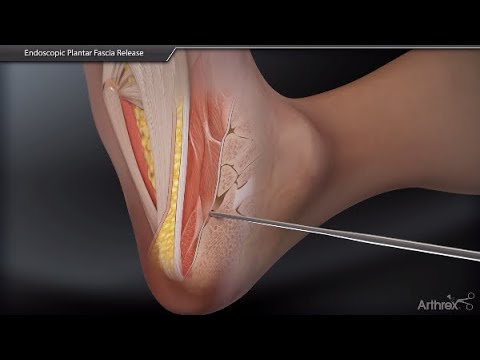 YouTube video about: Can cryotherapy help plantar fasciitis?