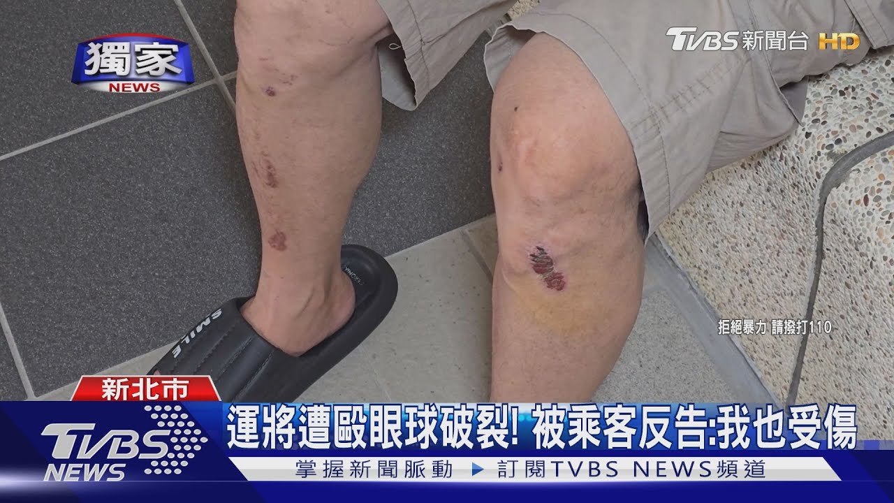 控載客上台64線遭毆! 運將眼球破裂、牙斷