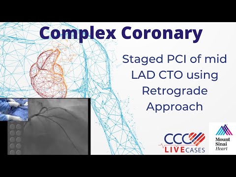 Staged PCI of mid LAD CTO using Retrograde Approach - September 17, 2013 Webcast Video