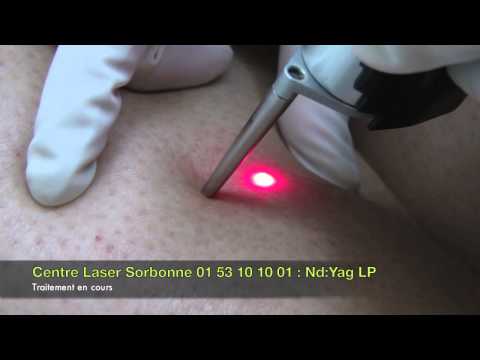 comment traiter angiome