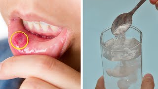 4 RECEITAS NATURAIS SECRETAS PARA CURAR AFTA NA BOCA EM CASA