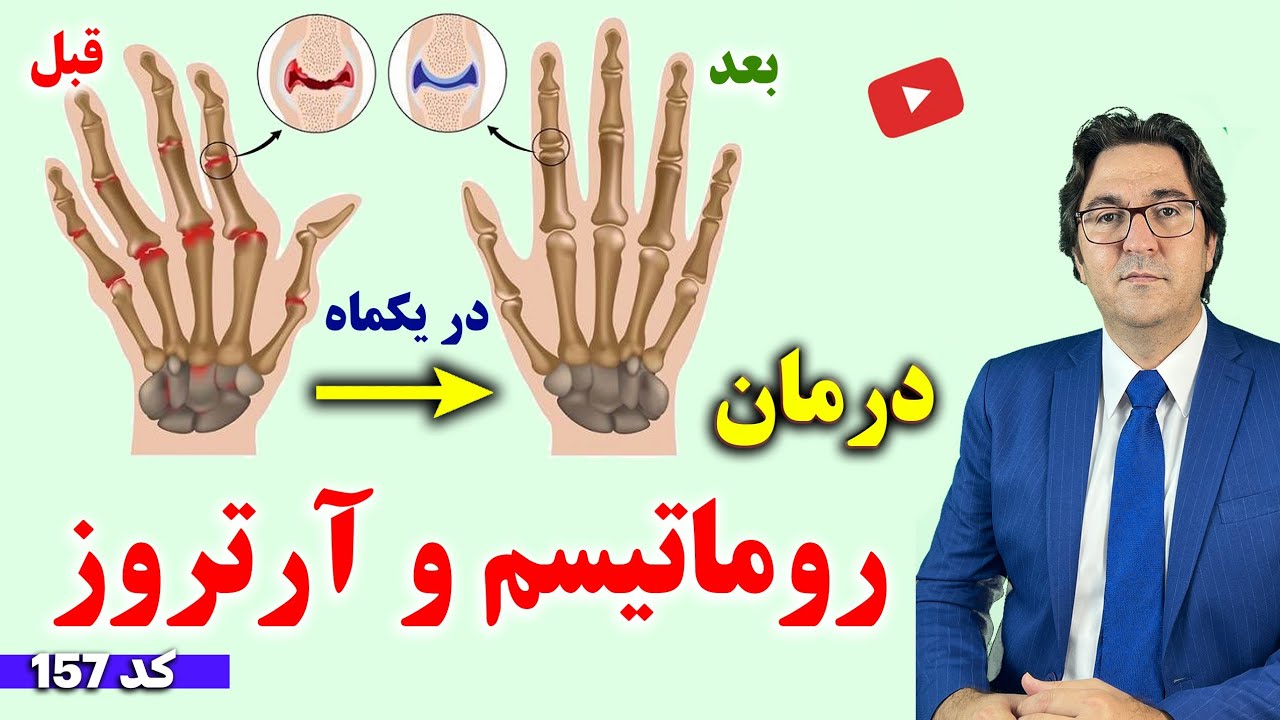 برای درمان آرتروز و روماتیسم چی بخوریم چی نخوریم؟ | با آرتروز انگشتان و روماتیسم مفاصل خداحافظی کن!