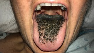 BLACK HAIRY TONGUE?! How To Get Rid Of It 👅