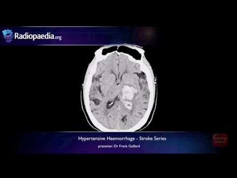 Stroke: Hypertensive haemorrhage - radiology video tutorial (MRI, CT)