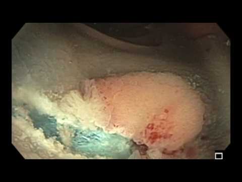 Colonoscopy: Rectosigmoid colon underwater EMR