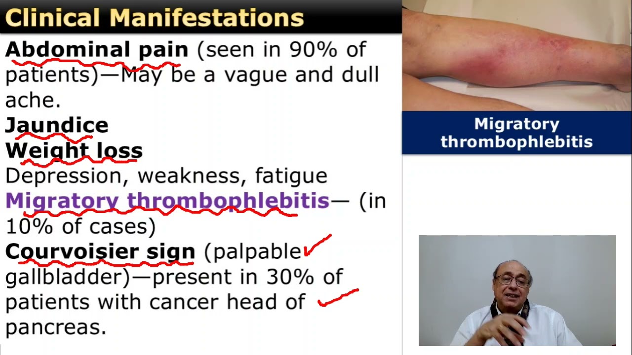Cancer of the Pancreas