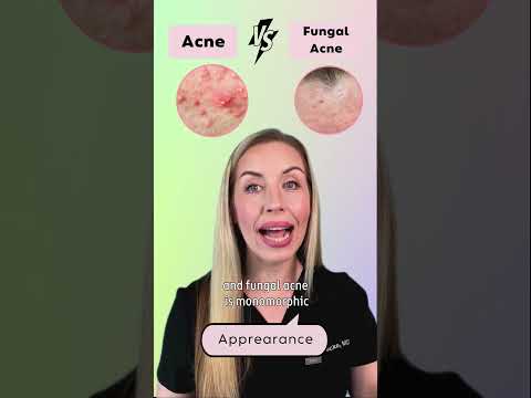 5 signs you have Fungal Acne, NOT regular acne!🙈