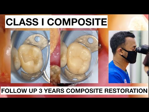 Dental Filling Composite Restoration After 3 Years