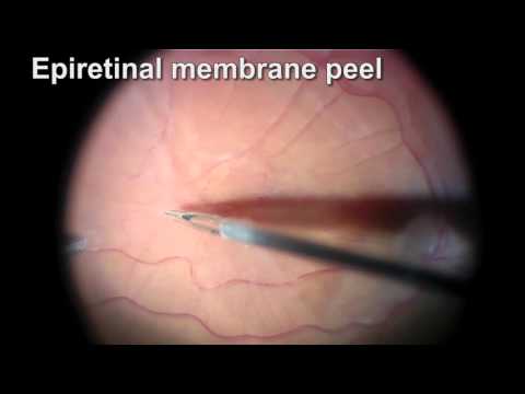 Vitrectomy for Macular Pucker 