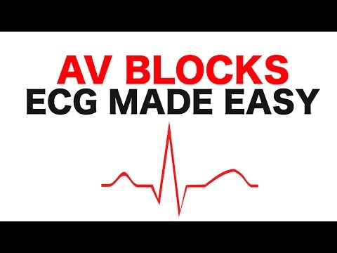 AV Blocks (1st, 2nd, and 3rd Degree)